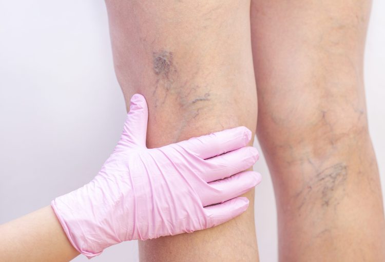 Female legs with varicose veins. At the doctors surgeons appointment. doctors hands in gloves. Concept of human health and disease. Vascular diseases, problems of varicose veins